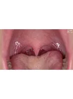 AD-01-017 -  Observation of tongue tongue, teeth, and mouth Fu Koizumi